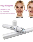 Blue Light Therapy Acne Laser Pen